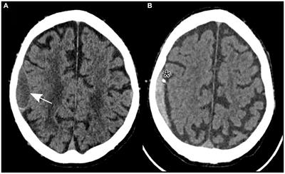 Case report: Concurrent low-volume subdural hematoma and ipsilateral ischemic stroke presenting as capsular warning syndrome: a complex case with anticoagulation dilemma and dual pathology